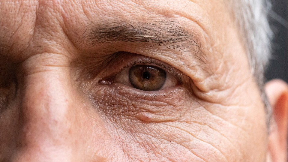 Age related Macular Degeneration