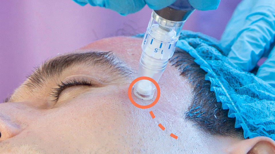 Mesoteràpia facial