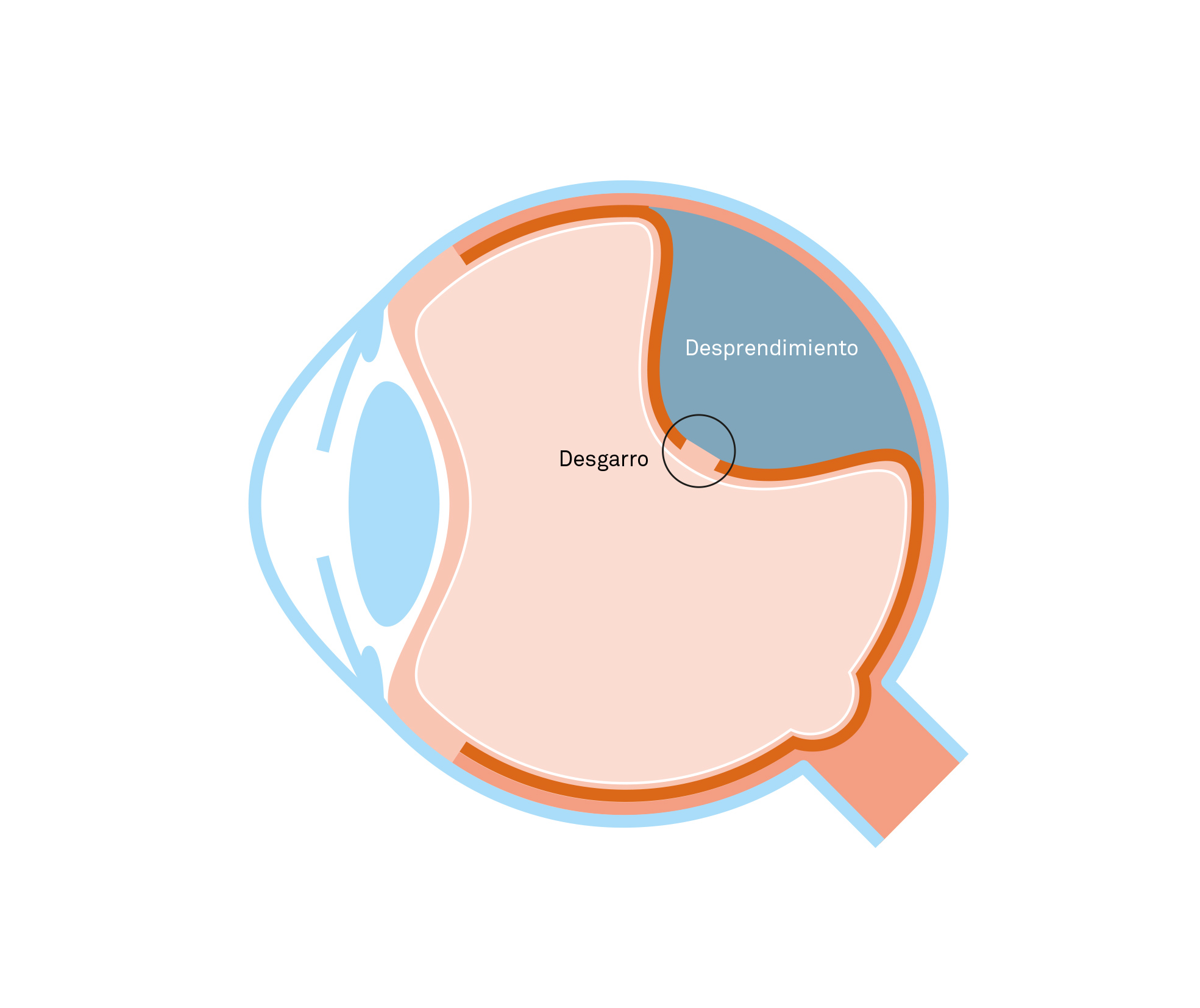 Ojo con desprendimiento de retina