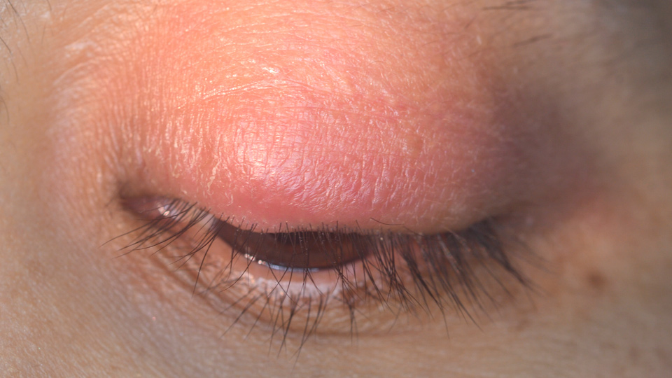 Celulitis ocular