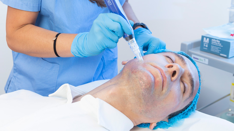 Microneedling